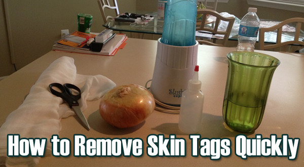 Skin Tag Removal Home Remedies