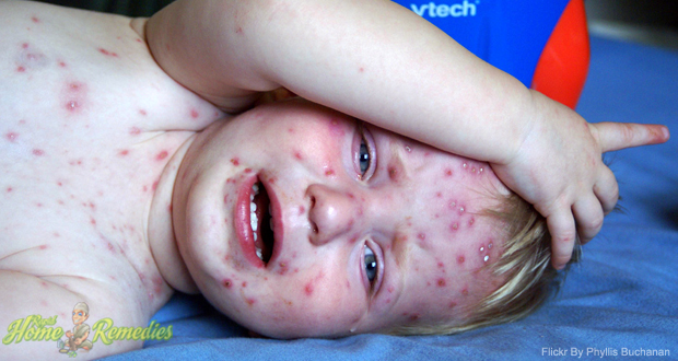 Chickenpox - KidsHealth