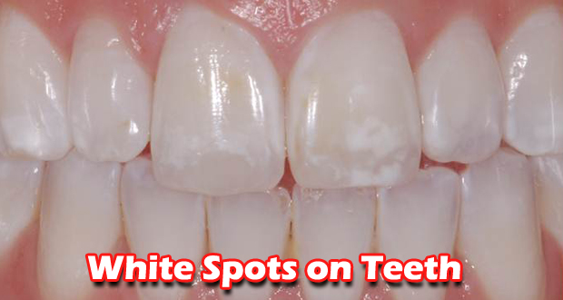 Home / How To / How to Get Rid of White Spots on Teeth Fast