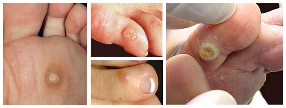 Corns and Calluses Picture Image on MedicineNet.com