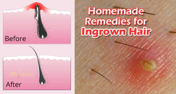 How to Get Rid of Ingrown Hair