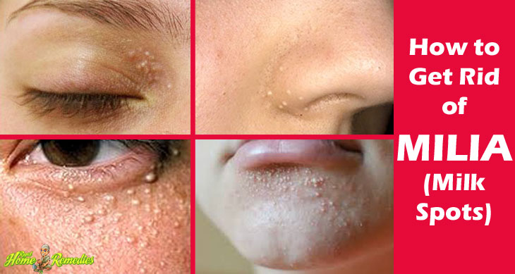 13 Best Ways To Get Rid Of Milia Milk Spots 26 Are Best