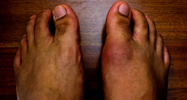 does allopurinol stop gout attacks