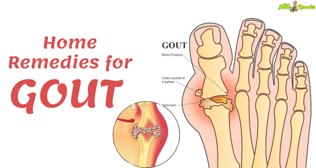 10 Most Effective Home Remedies for Gout