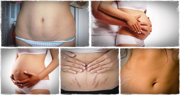 Home remedies for Stretch Marks