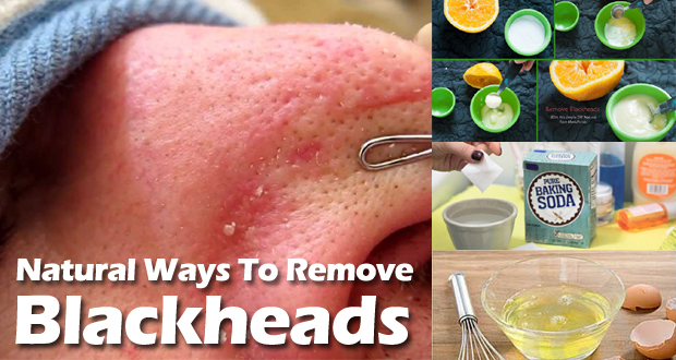 Natural Remedies To Remove Blackheads