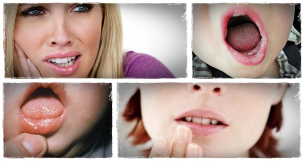 Remedies for Canker Sores