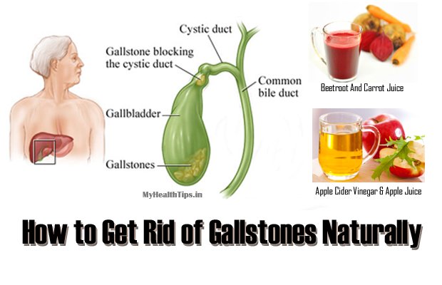 Remedies for Gallstones