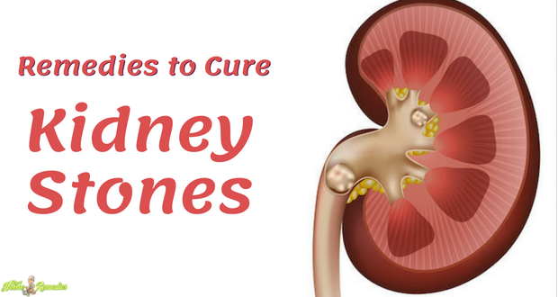 Herbal Remedies to Cure Kidney Stones