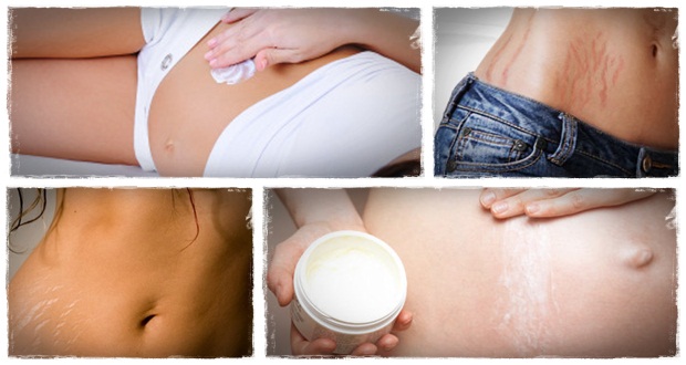Top 10 Remedies to Remove Stretch Marks