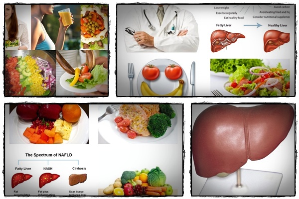 fatty liver diet 