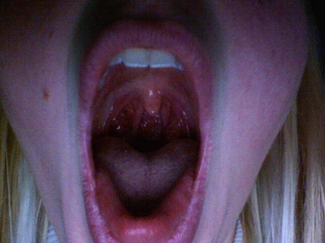 9 Simple Ways to Cure Sore throat