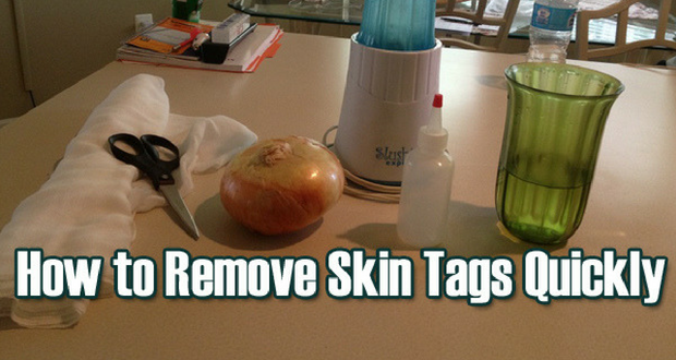 remedies for skin tag