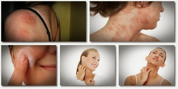 Herbal Remedies for Eczema