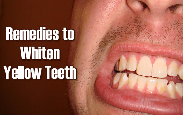 5 Surprising Remedies to Whiten Yellow Teeth