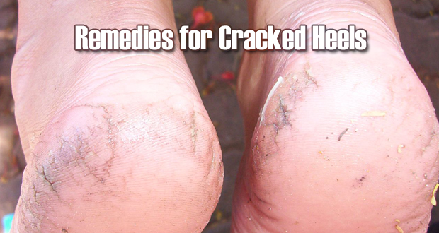 Ways to Cure Cracked Heels