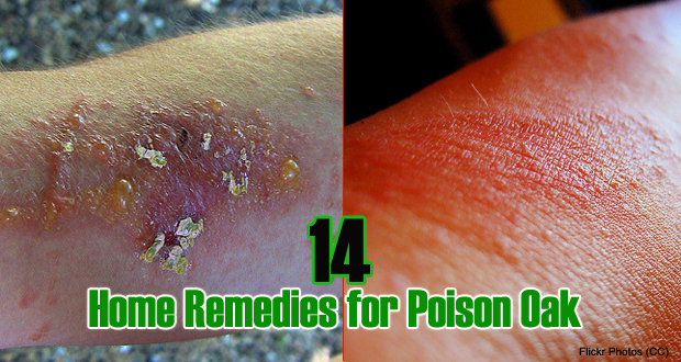 Home Remedies for Poison Oak