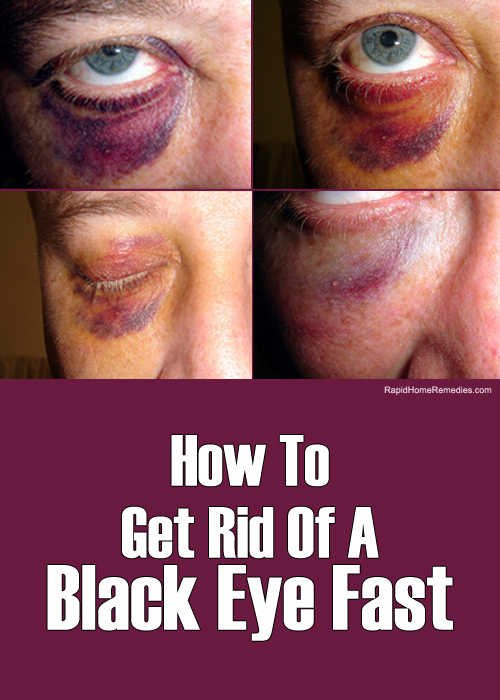 Simple Ways to Get Rid of Black Eye