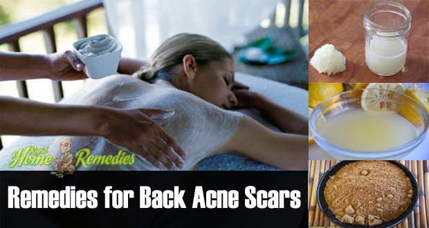 Back Acne Scars