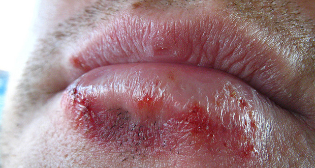 Herbal Remedies for Herpes