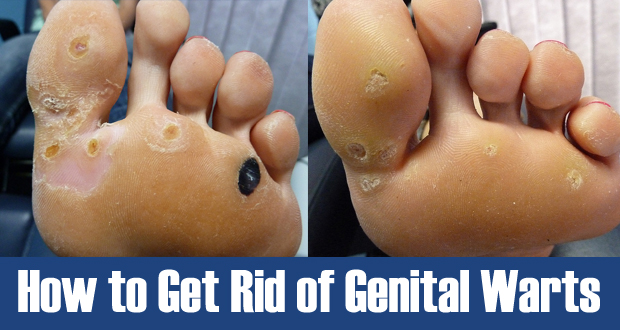 How to Get Rid of Genital Warts