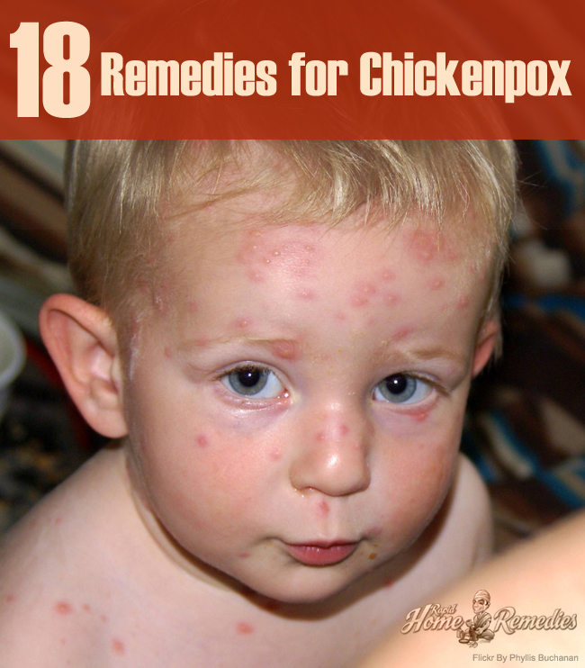 Natural Remedies for Chickenpox