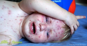 Remedies for Chickenpox