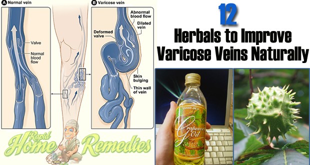 Remedies for Varicose Veins