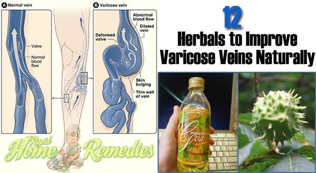 Top 12 Home Herbal Remedies for Varicose Veins