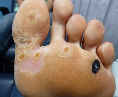 Remedies for warts