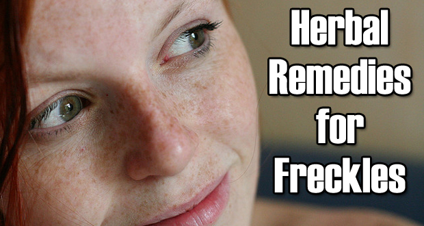 Herbal Remedies for Freckles