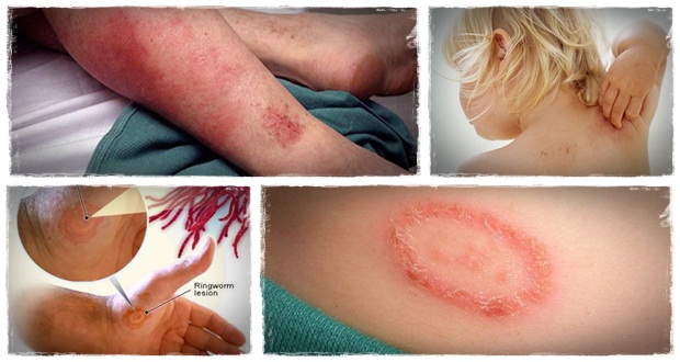 17 Herbal Remedies for Ringworm