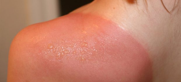 how to make sunburn not itch