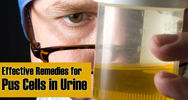 Remedies for Pus Cells in Urine
