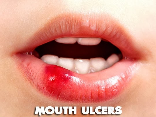 remedies for mouth ulcers