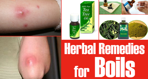 15 Herbal Remedies for Boils