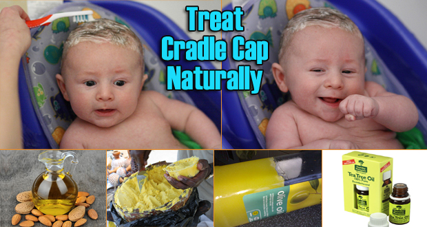 natural cure for cradle cap