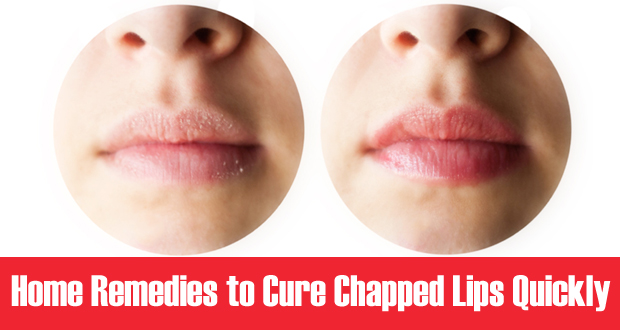 Home Remedies to cure Chapped Lips