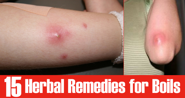 Natural Remedies for Boils