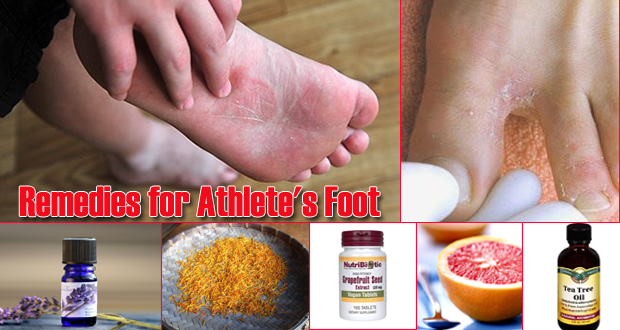 17 Home Remedies for Athlete’s Foot