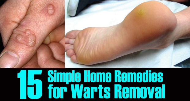 Remedies for Warts Removal