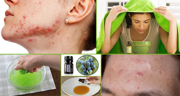 Natural Remedies to Get Rid of Cystic Acne Fast