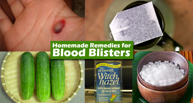 Effective Home Remedies for Blood Blisters