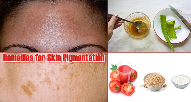 Remedies for Skin Pigmentation