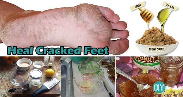 Ways to Heal Cracked Feet