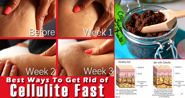 How to Get Rid of Cellulite 