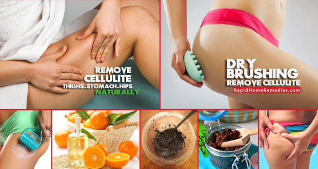 Top Remedies for Cellulite Removal