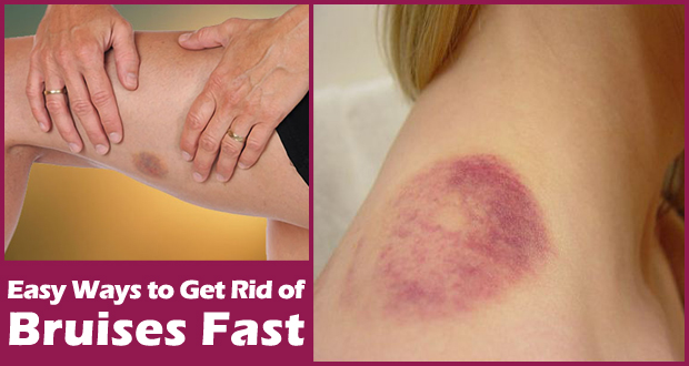 How to Get Rid of Bruises Fast