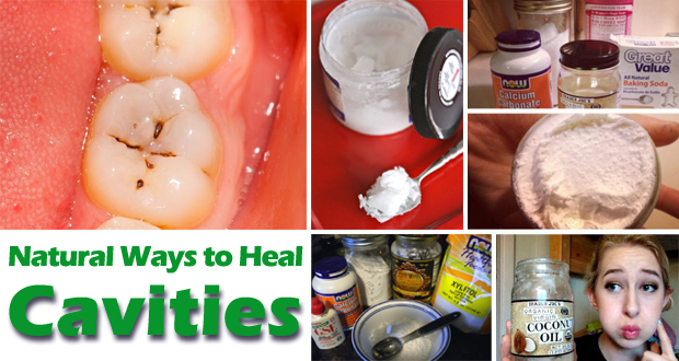 How to Heal Cavities Naturally