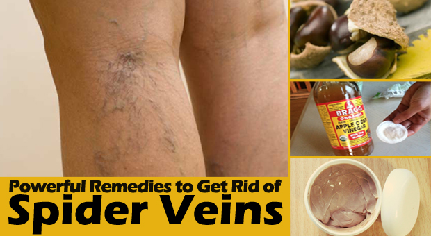 How to Get Rid of Spider Veins